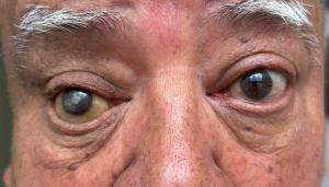 blog ¿Cuál es la vida útil de una prótesis ocular?