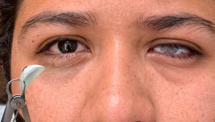 ¿Tengo que operarme para usar una prótesis ocular?