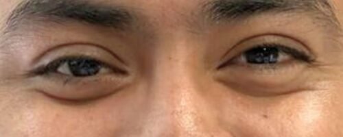 Caso Alan: Paciente con desprendimiento de retina por traumatismo