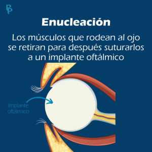 Enucleación e implante ocular