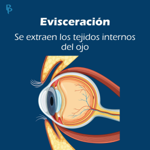 Evisceración ocular