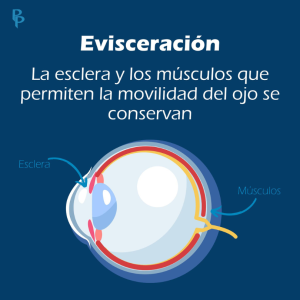 Evisceracion ocular movilidad