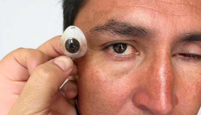 5 Ventajas de una Prótesis Ocular Personalizada