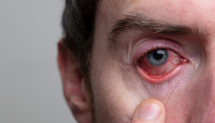 Quemaduras químicas en ojos