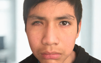 ¿Cuándo debo cambiar mi prótesis ocular?