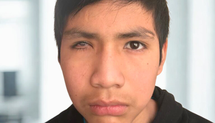 ¿Cuándo debo cambiar mi prótesis ocular?