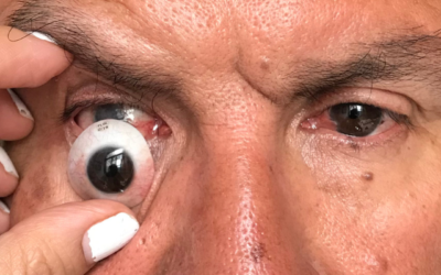 Ventajas de usar una prótesis ocular