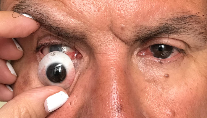 Ventajas de usar una prótesis ocular