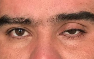 Uso una prótesis ocular y mi párpado parece caído ¿tengo que operarme?