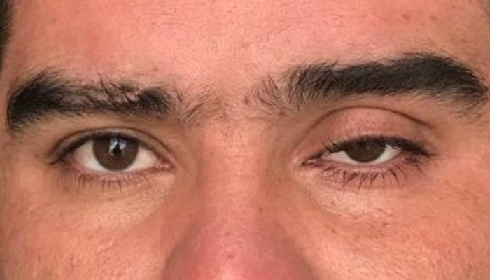 Uso una prótesis ocular y mi párpado parece caído ¿tengo que operarme?