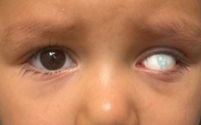 5 ventajas de usar una prótesis ocular desde temprana edad