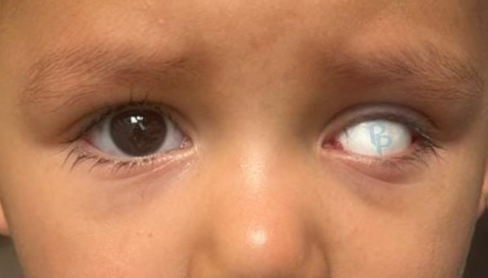 5 ventajas de usar una prótesis ocular desde temprana edad