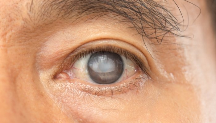 ¿Qué es el glaucoma y cuáles son los daños que provoca?