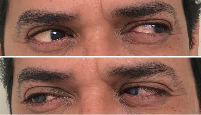 ¿Qué es la movilidad en las prótesis oculares y por qué importa?