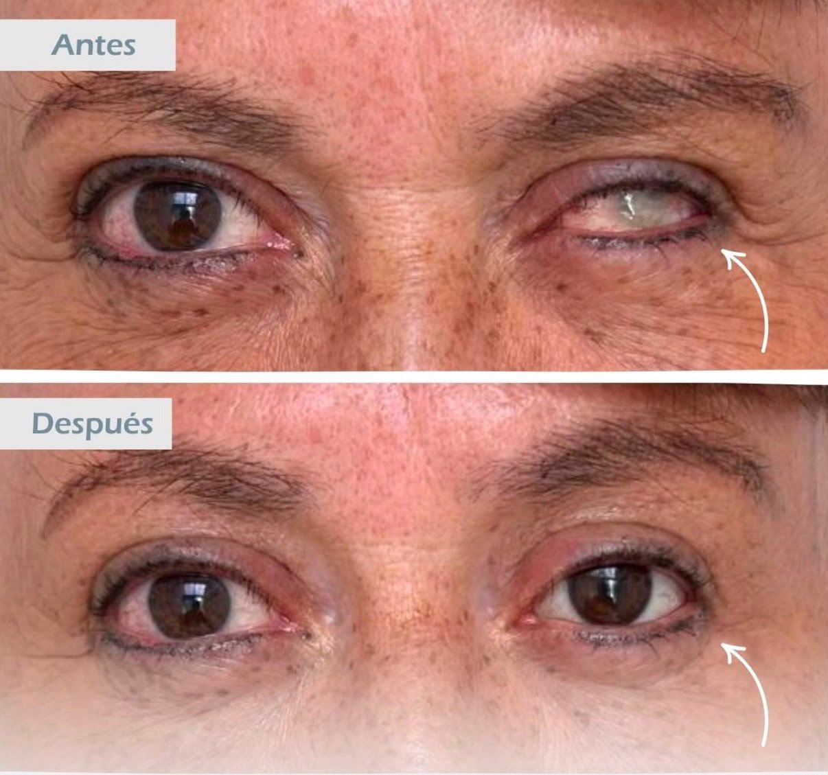 Resultado antes y después de prótesis ocular