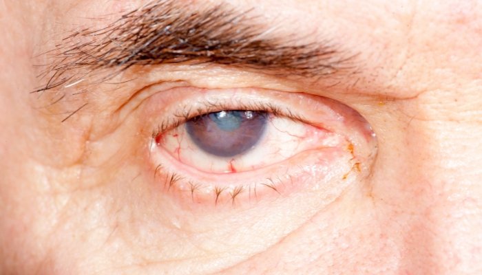 ¿Cómo afecta la diabetes a la recuperación y al uso de una prótesis ocular?